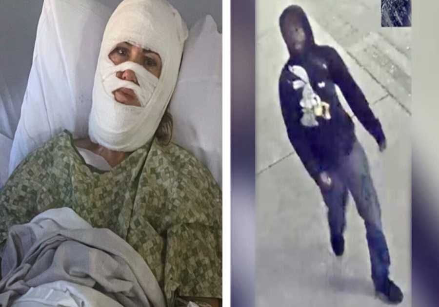 HORROR: Georgia Woman Suffers Severe Burns to Her Face, Neck and Scalp After Stranger Douses Her with Acid at Park – Suspect at Large