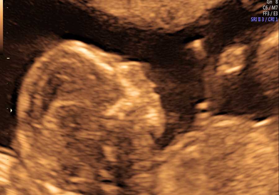 Puerto Rico Enacts Groundbreaking Law Recognizing Unborn Babies as Persons from Conception