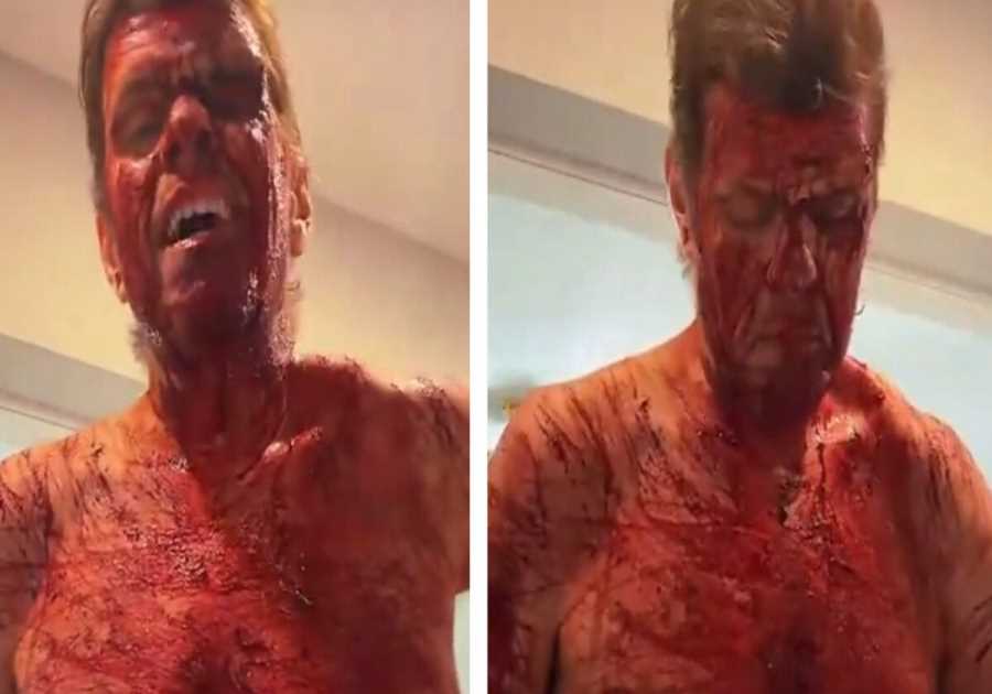 Celebrity Blogger Perez Hilton Still Hospitalized After Cutting Himself on TikTok Live, Will Need Surgery